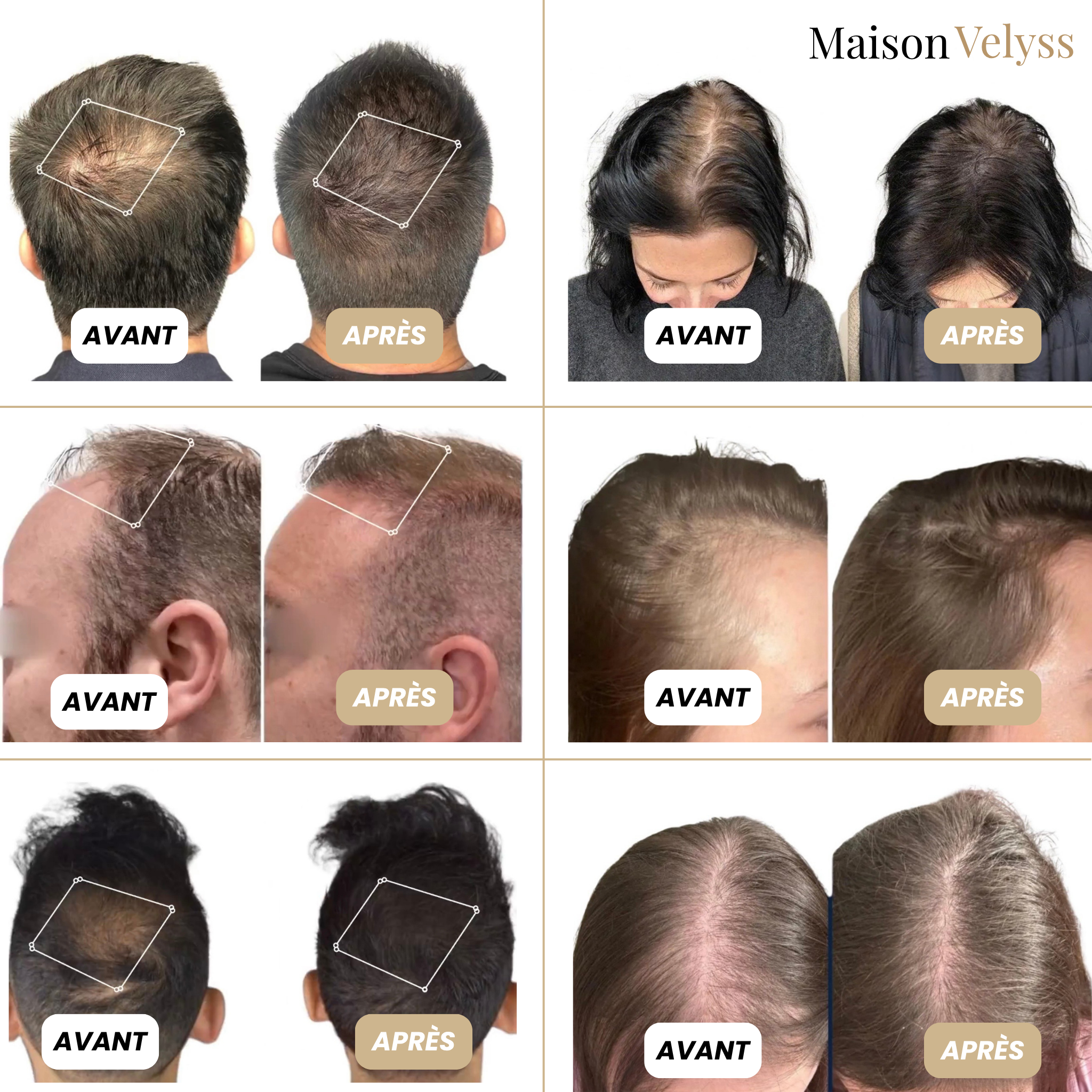 Protocole Velyss — Repousse Capillaire Naturelle